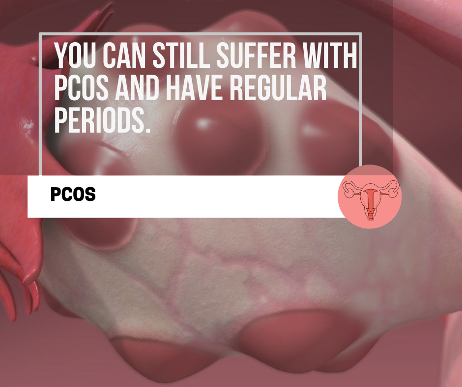 PCOS & Regular Periods
