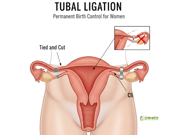 Can You Untie Your Tubes? 2025 Powerful Guidance for Family Planning